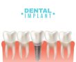 אפשרויות מתקדמות לשיקום מערכת השיניים והפה